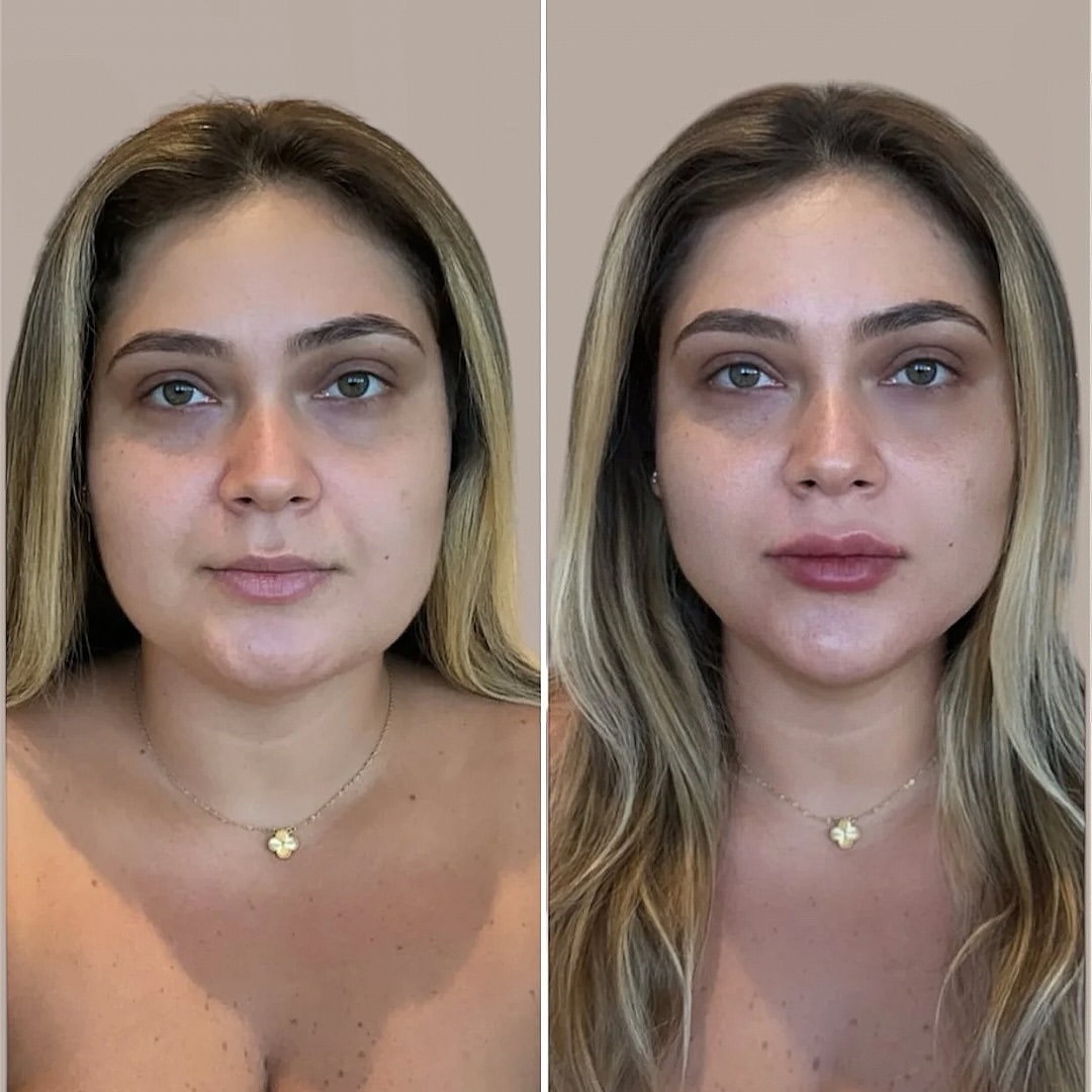Antes e depois de procedimento estético